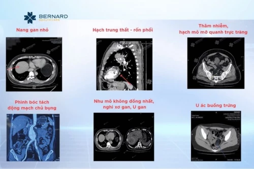 CT Scan bụng – chậu giúp phát hiện những tổn thương ổ bụng dễ bị bỏ sót